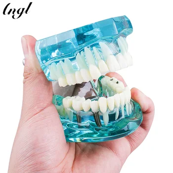1 Gabalas Dantų Mėlyna Skaidri Suaugusiųjų Dantų Dervos Atkūrimo Modelis, Odontologijos Medžiagos, Odontologijos Priemonės, Stomatologija Laboratorija Modelis
