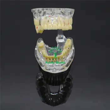 1 X Dantų Implantai Liga, Danties Patologijos Ekstruzijos Trūkstamus Dantis Naujas Modelis