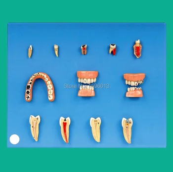 Dantų Ligų Modelį, Dantų pažeidimai serijos modelis