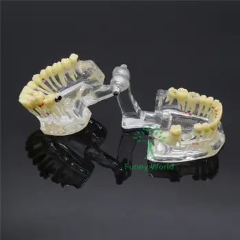 1 X Dantų Implantai Liga, Danties Patologijos Ekstruzijos Trūkstamus Dantis Naujas Modelis