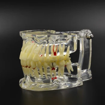 Dantų Implantai Liga, Danties Patologijos Štampavimo, Trūksta Su paveikti, danties, dantų patologijos, dantų implantas