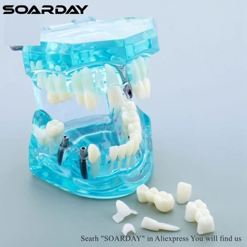 SOARDAY 1pc Dantų Išsamią Mokymo Modelį Dantų Ligas ir dantų Protezavimas
